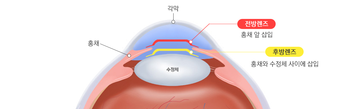안내렌즈삽입술이미지